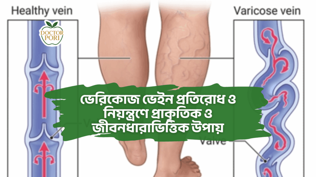 ভেরিকোজ ভেইন প্রতিরোধ ও নিয়ন্ত্রণে প্রাকৃতিক ও জীবনধারাভিত্তিক উপায় 2 ভেরিকোজ ভেইন প্রতিরোধ ও নিয়ন্ত্রণে প্রাকৃতিক ও জীবনধারাভিত্তিক উপায়