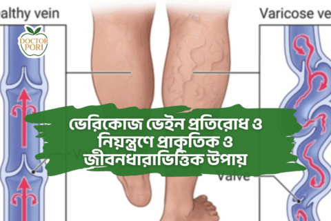 ভেরিকোজ ভেইন প্রতিরোধ ও নিয়ন্ত্রণে প্রাকৃতিক ও জীবনধারাভিত্তিক উপায়