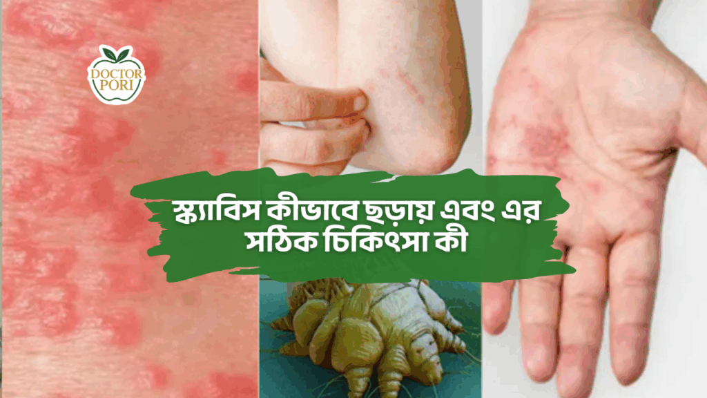 স্ক্যাবিস কীভাবে ছড়ায় এবং এর সঠিক চিকিৎসা কী