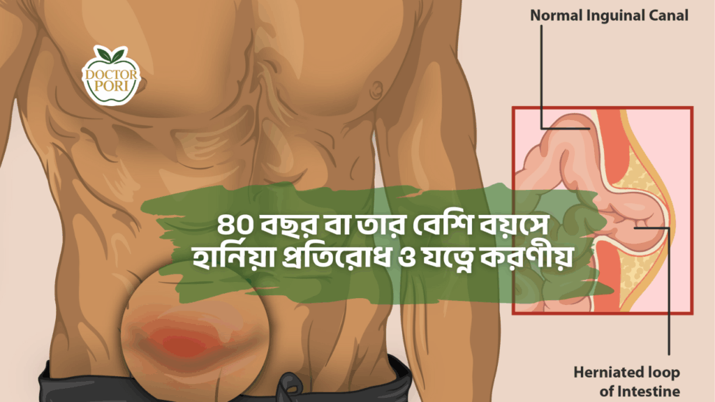 ৪০ বছর বা তার বেশি বয়সে হার্নিয়া প্রতিরোধ ও যত্নে করণীয়
