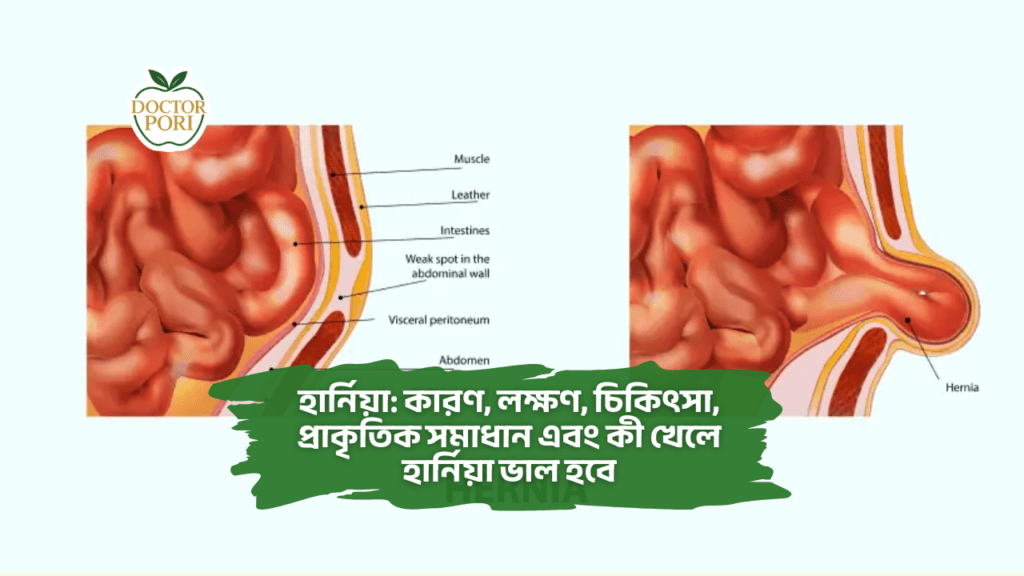 হার্নিয়া: কারণ, লক্ষণ, চিকিৎসা, প্রাকৃতিক সমাধান এবং কী খেলে হার্নিয়া ভাল হবে